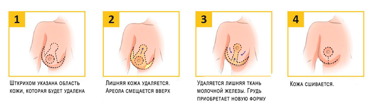 этапы редукционной маммопластики