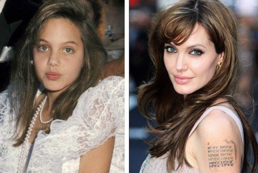 Анджелина Джоли о и после удаления комков Биша