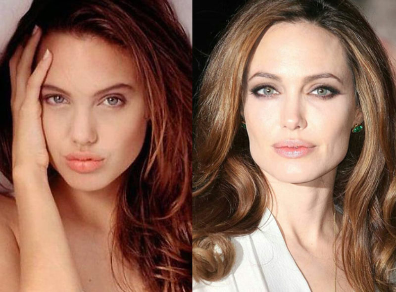 маммопластика Анджелины Джоли