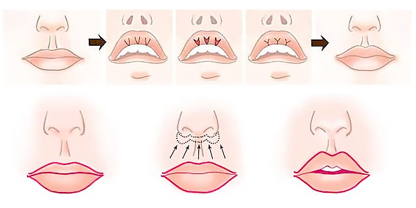 этапы увеличения верхней губы