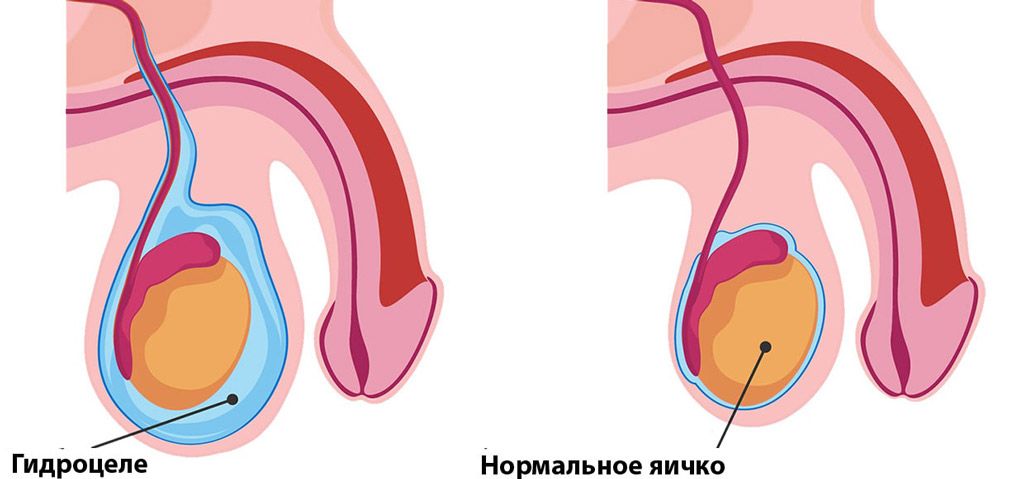 области проведения операции гидроцеле