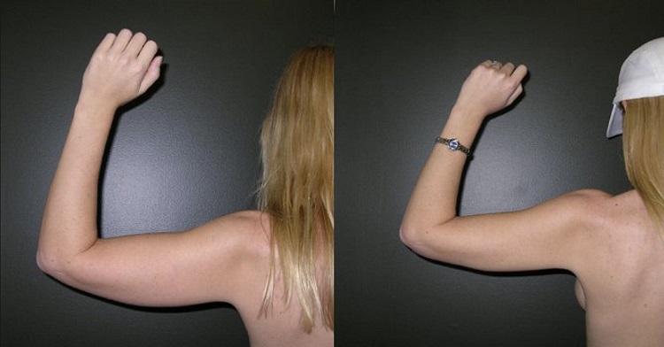 липосакция рук фото до и после