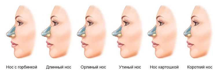 показания к ринопластике по типу носа