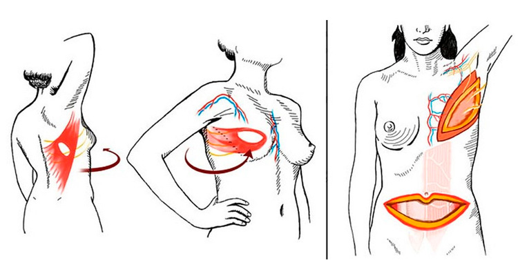 технология восстановления груди TRAM лоскутом