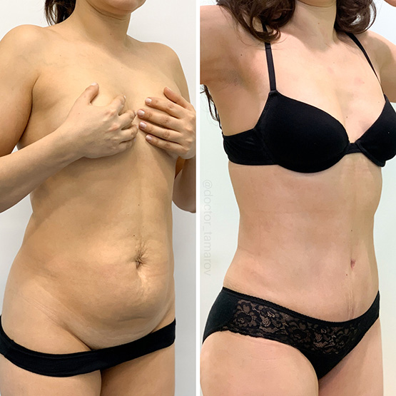 фото до и после ушивания диастаза